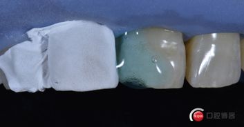 门牙切角缺损树脂充填