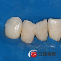 树脂修复两例